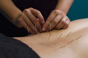 Myotherapy - Dry Needling